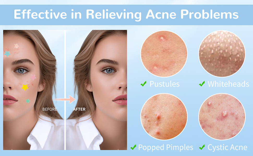 pimple patches for face